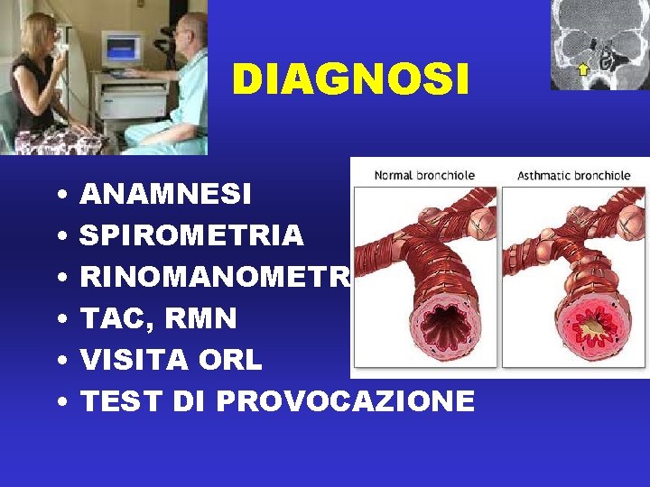 DIAGNOSI • • • ANAMNESI SPIROMETRIA RINOMANOMETRIA TAC, RMN VISITA ORL TEST DI PROVOCAZIONE