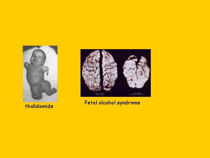 thalidomide Fetal alcohol syndrome 