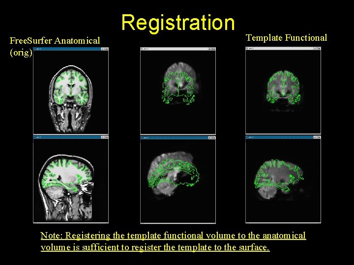 Registration Free. Surfer Anatomical (orig) Template Functional Note: Registering the template functional volume to