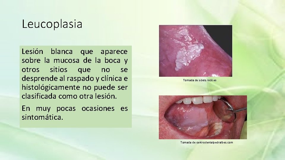 Leucoplasia Lesin blanca que aparece sobre la mucosa