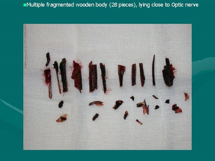 n. Multiple fragmented wooden body (28 pieces), lying close to Optic nerve n. Multiple fragmented wooden body (28 pieces), lying close to Optic nerve