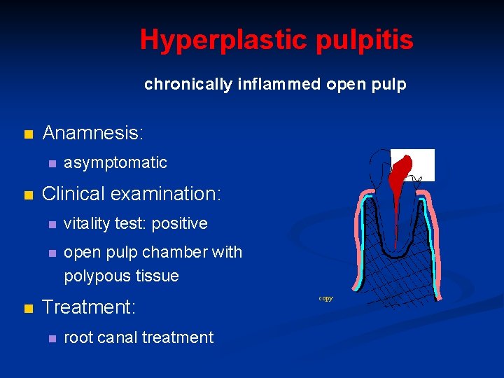 Hyperplastic pulpitis chronically inflammed open pulp n Anamnesis: n n n asymptomatic Clinical examination: