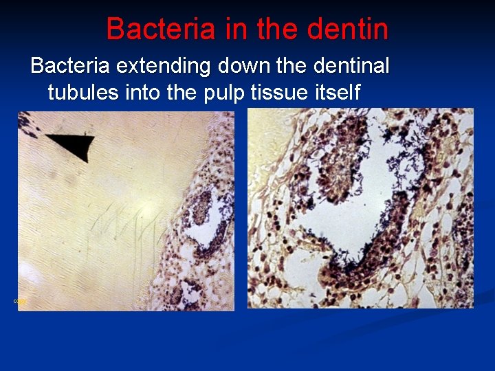 Bacteria in the dentin Bacteria extending down the dentinal tubules into the pulp tissue