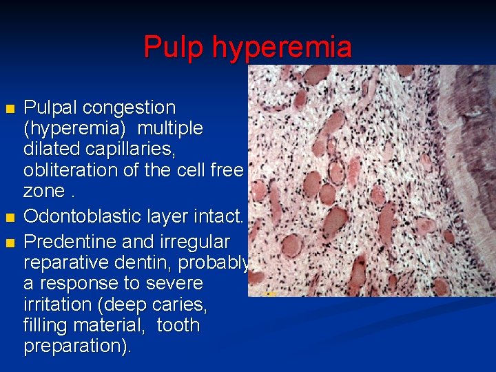 Pulp hyperemia n n n Pulpal congestion (hyperemia) multiple dilated capillaries, obliteration of the