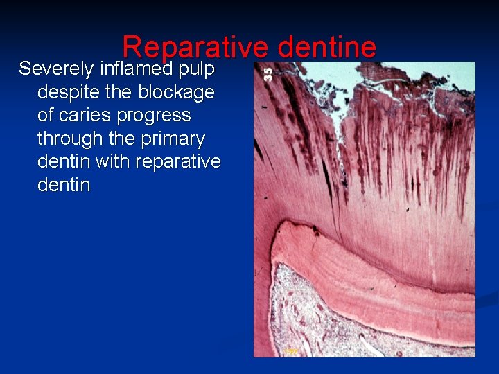 Reparative dentine Severely inflamed pulp despite the blockage of caries progress through the primary