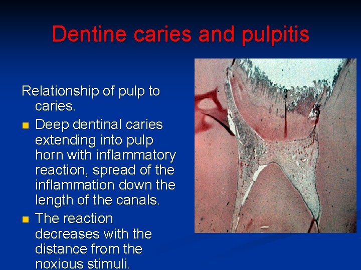 Dentine caries and pulpitis Relationship of pulp to caries. n Deep dentinal caries extending