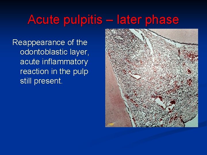 Acute pulpitis – later phase Reappearance of the odontoblastic layer, acute inflammatory reaction in