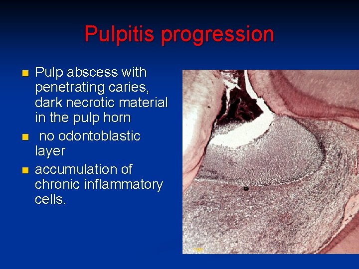 Pulpitis progression n Pulp abscess with penetrating caries, dark necrotic material in the pulp