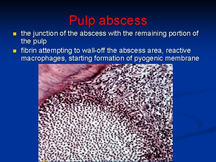 Pulp abscess n n the junction of the abscess with the remaining portion of