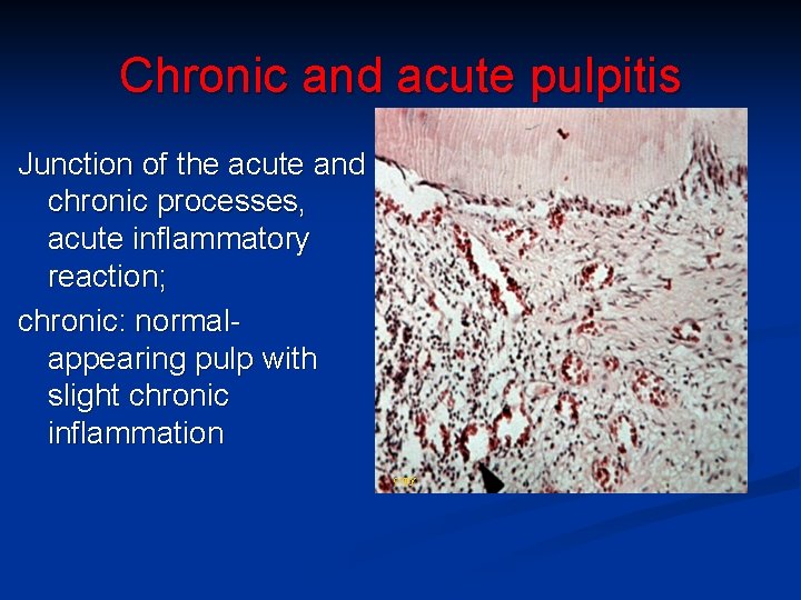 Chronic and acute pulpitis Junction of the acute and chronic processes, acute inflammatory reaction;