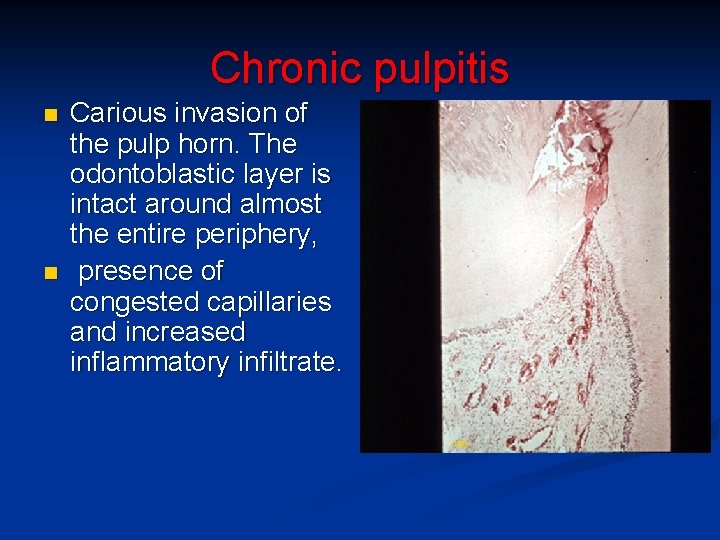 Chronic pulpitis n n Carious invasion of the pulp horn. The odontoblastic layer is