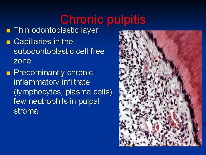 Chronic pulpitis n n n Thin odontoblastic layer Capillaries in the subodontoblastic cell-free zone