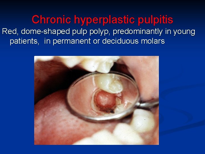 Chronic hyperplastic pulpitis Red, dome-shaped pulp polyp, predominantly in young patients, in permanent or