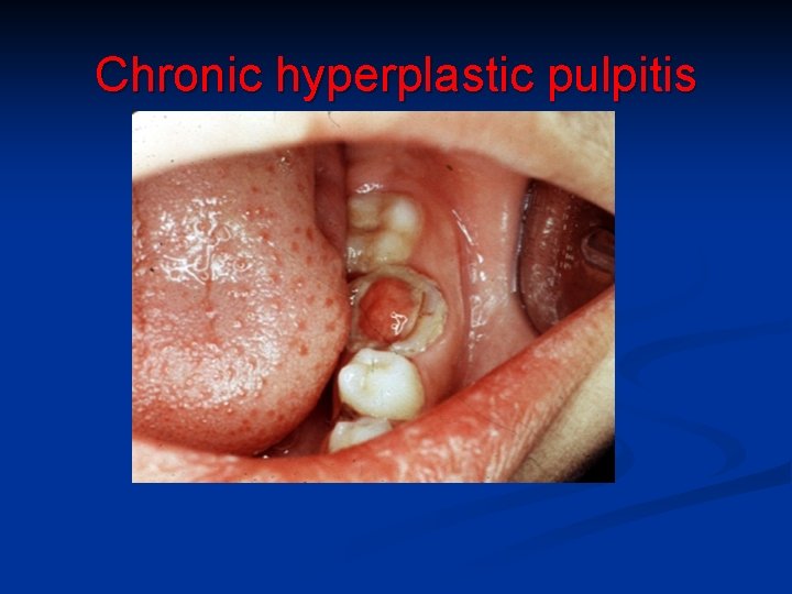 Chronic hyperplastic pulpitis 