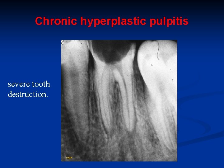 Chronic hyperplastic pulpitis severe tooth destruction. copy 