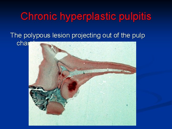 Chronic hyperplastic pulpitis The polypous lesion projecting out of the pulp chamber. 
