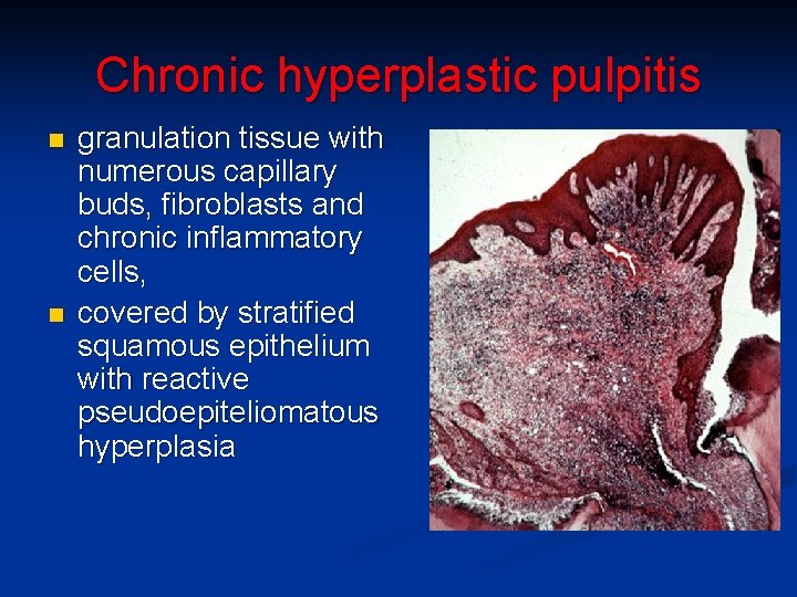 Chronic hyperplastic pulpitis n n granulation tissue with numerous capillary buds, fibroblasts and chronic