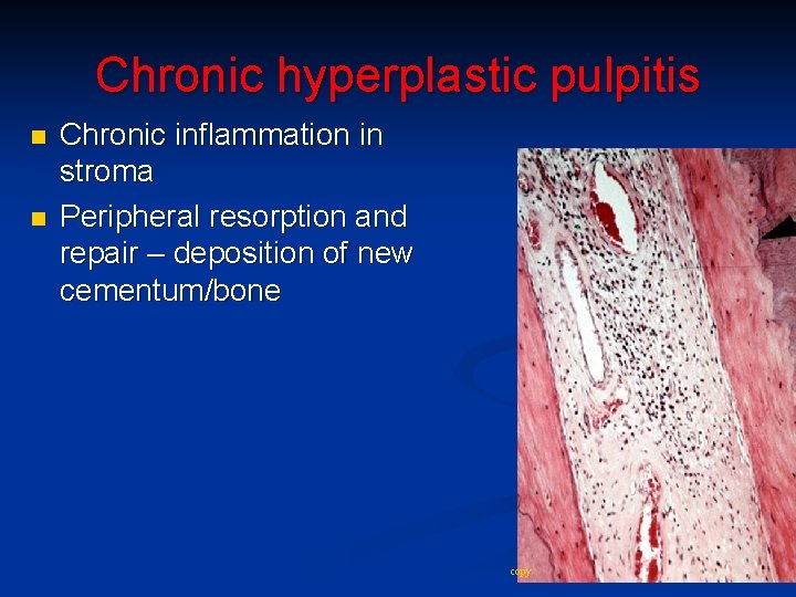 Chronic hyperplastic pulpitis n n Chronic inflammation in stroma Peripheral resorption and repair –