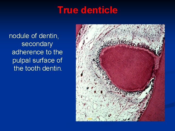 True denticle nodule of dentin, secondary adherence to the pulpal surface of the tooth