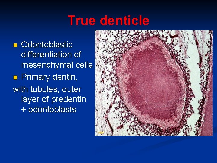 True denticle Odontoblastic differentiation of mesenchymal cells n Primary dentin, with tubules, outer layer