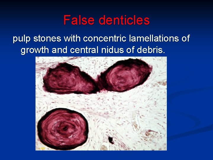 False denticles pulp stones with concentric lamellations of growth and central nidus of debris.