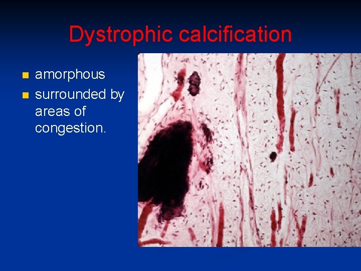 Dystrophic calcification n n amorphous surrounded by areas of congestion. 