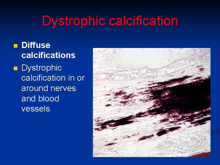 Dystrophic calcification n n Diffuse calcifications Dystrophic calcification in or around nerves and blood