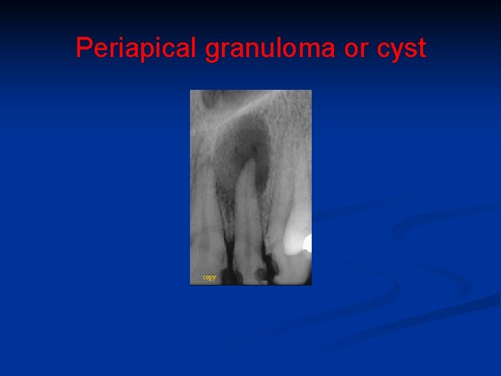 Periapical granuloma or cyst copy 