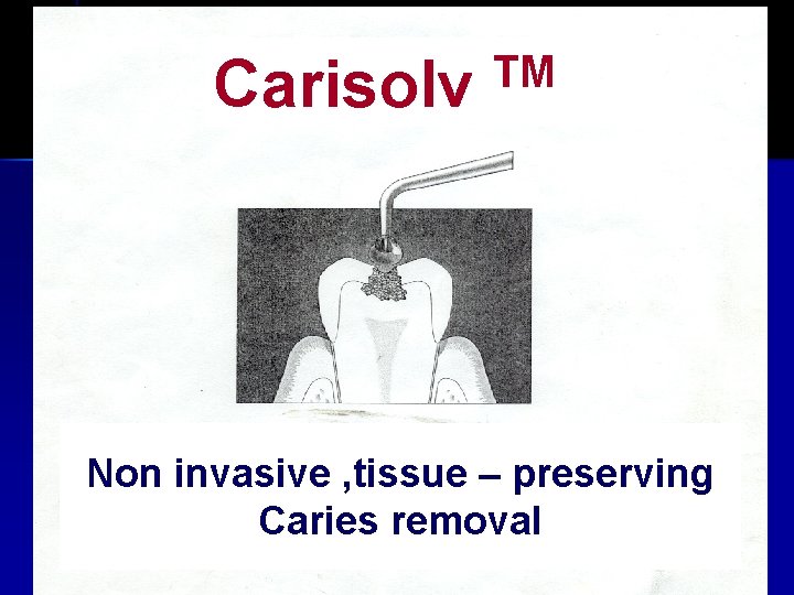 Carisolv TM Non invasive , tissue – preserving Caries removal 