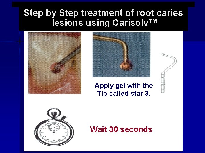 Step by Step treatment of root caries lesions using Carisolv. TM Apply gel with