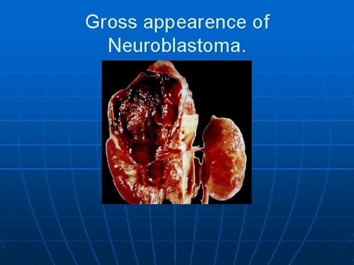 Gross appearence of Neuroblastoma. 