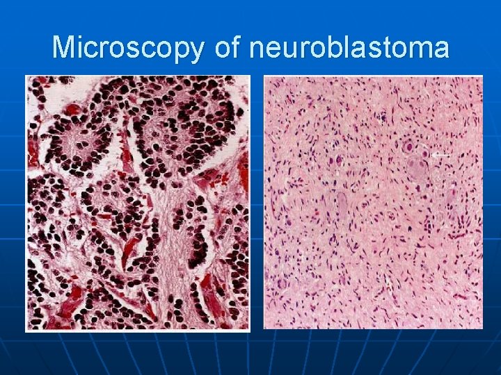 Microscopy of neuroblastoma Microscopy of neuroblastoma