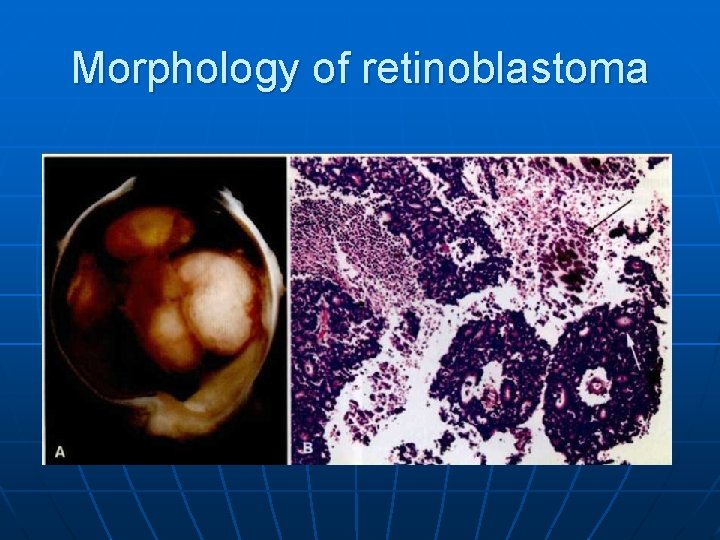 Morphology of retinoblastoma Morphology of retinoblastoma