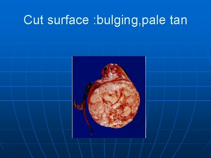 Cut surface : bulging, pale tan 