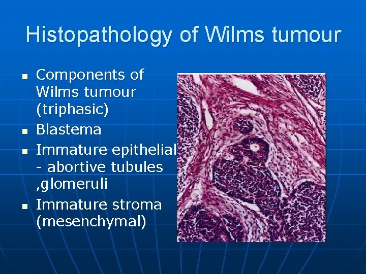 Histopathology of Wilms tumour n n Components of Wilms tumour (triphasic) Blastema Immature epithelial