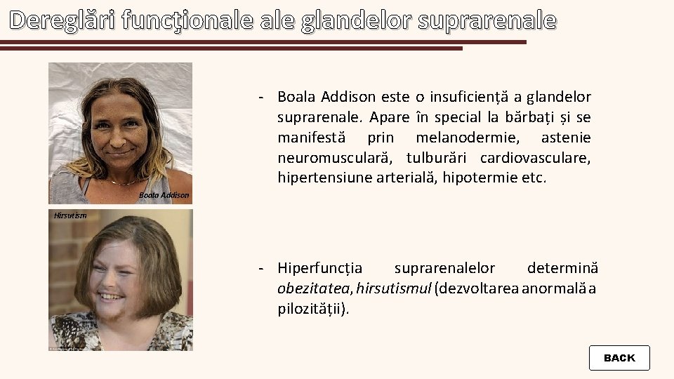 Dereglări funcţionale glandelor suprarenale - Boala Addison este o insuficiență a glandelor suprarenale. Apare