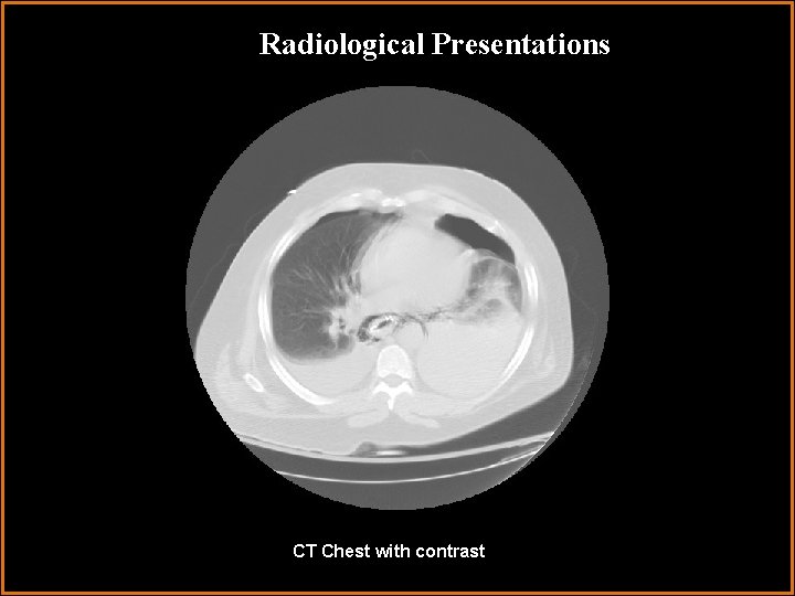 Radiological Presentations CT Chest with contrast 