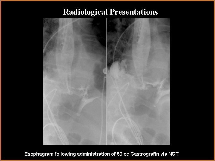 Radiological Presentations Esophagram following administration of 50 cc Gastrografin via NGT 