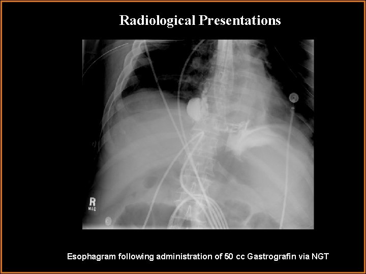 Radiological Presentations Esophagram following administration of 50 cc Gastrografin via NGT 