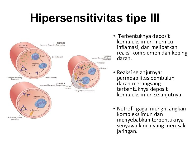 Hipersensitivitas tipe III • Terbentuknya deposit kompleks imun memicu inflamasi, dan melibatkan reaksi komplemen