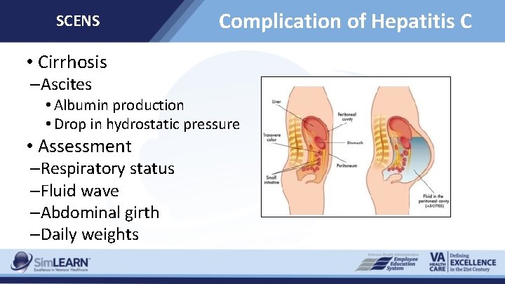 SCENS Complication of Hepatitis C • Cirrhosis –Ascites • Albumin production • Drop in