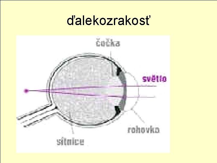 ďalekozrakosť 