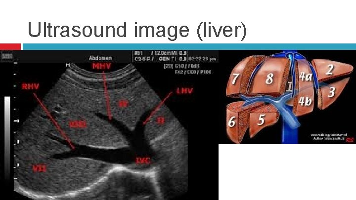 Ultrasound image (liver) 