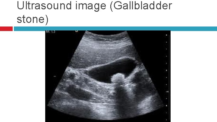 Ultrasound image (Gallbladder stone) 