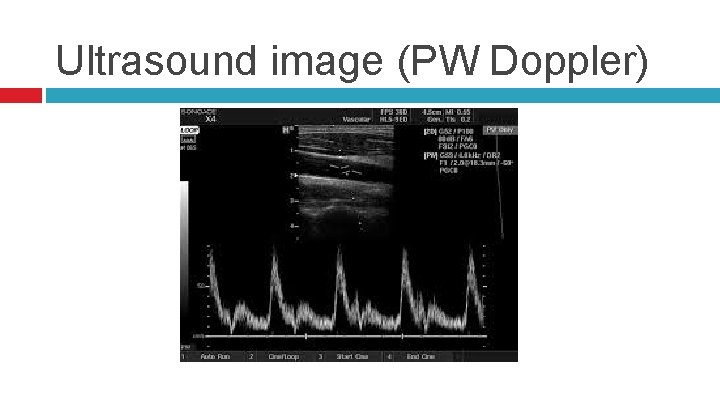 Ultrasound image (PW Doppler) 
