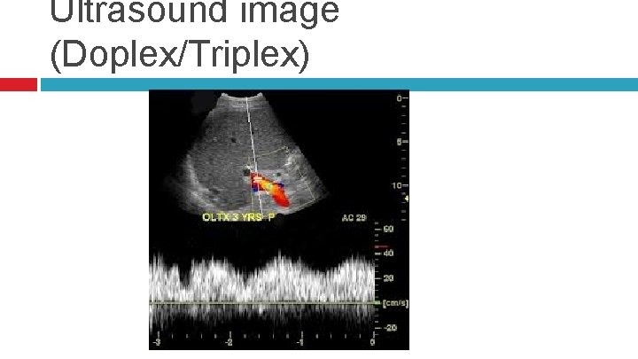 Ultrasound image (Doplex/Triplex) 