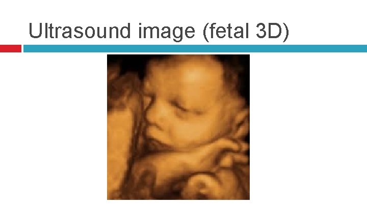 Ultrasound image (fetal 3 D) 