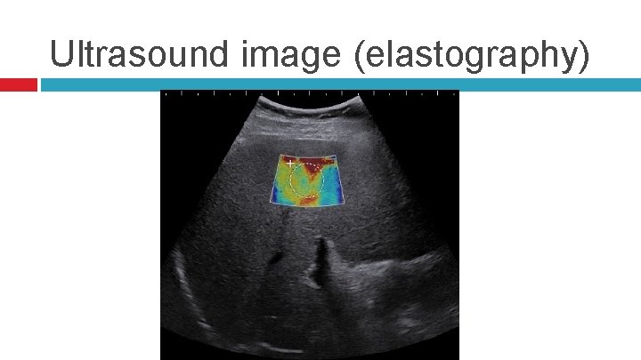 Ultrasound image (elastography) 