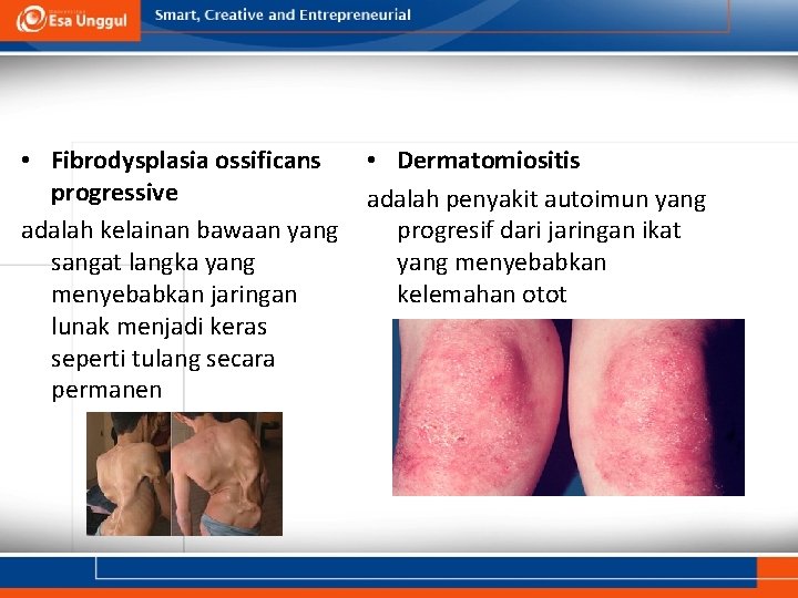  • Fibrodysplasia ossificans progressive adalah kelainan bawaan yang sangat langka yang menyebabkan jaringan