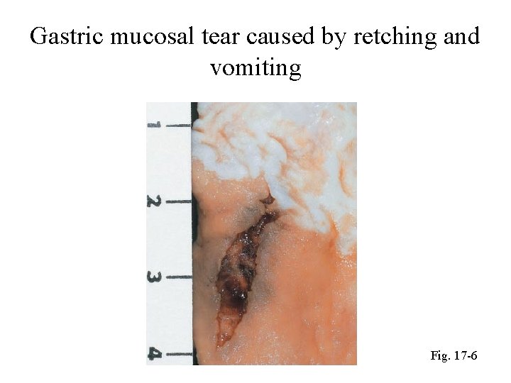 Gastric mucosal tear caused by retching and vomiting Fig. 17 -6 